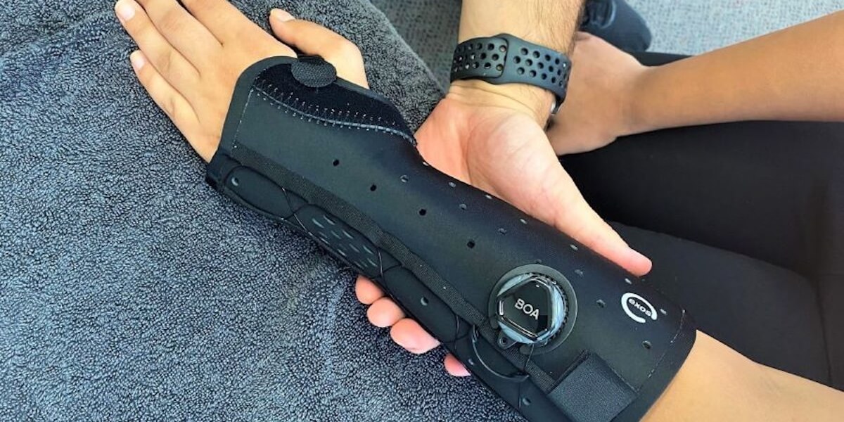EXOS casts for fractured wrists and forearms